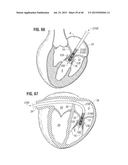 PROSTHETIC VALVE FOR REPLACING MITRAL VALVE diagram and image