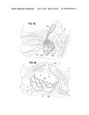 PROSTHETIC VALVE FOR REPLACING MITRAL VALVE diagram and image