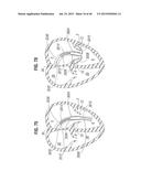 PROSTHETIC VALVE FOR REPLACING MITRAL VALVE diagram and image