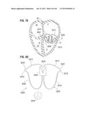 PROSTHETIC VALVE FOR REPLACING MITRAL VALVE diagram and image