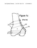 KNEE HINGE FIXATION APPARATUS AND METHOD FOR APPLICATION THEREOF diagram and image