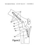 KNEE HINGE FIXATION APPARATUS AND METHOD FOR APPLICATION THEREOF diagram and image