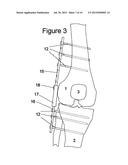 KNEE HINGE FIXATION APPARATUS AND METHOD FOR APPLICATION THEREOF diagram and image