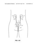 SYSTEM AND METHOD FOR ENDOLUMINAL AND TRANSLUMENAL THERAPY diagram and image