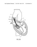 MEDICAL DEVICES AND DELIVERY SYSTEMS FOR DELIVERING MEDICAL DEVICES diagram and image