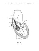 MEDICAL DEVICES AND DELIVERY SYSTEMS FOR DELIVERING MEDICAL DEVICES diagram and image