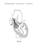 MEDICAL DEVICES AND DELIVERY SYSTEMS FOR DELIVERING MEDICAL DEVICES diagram and image