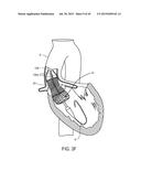 MEDICAL DEVICES AND DELIVERY SYSTEMS FOR DELIVERING MEDICAL DEVICES diagram and image