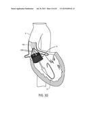 MEDICAL DEVICES AND DELIVERY SYSTEMS FOR DELIVERING MEDICAL DEVICES diagram and image