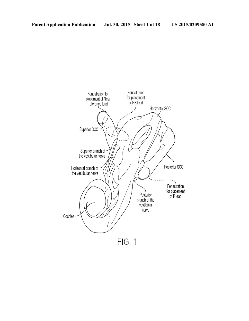 IMPLANTABLE VESTIBULAR PROSTHESIS - diagram, schematic, and image 02