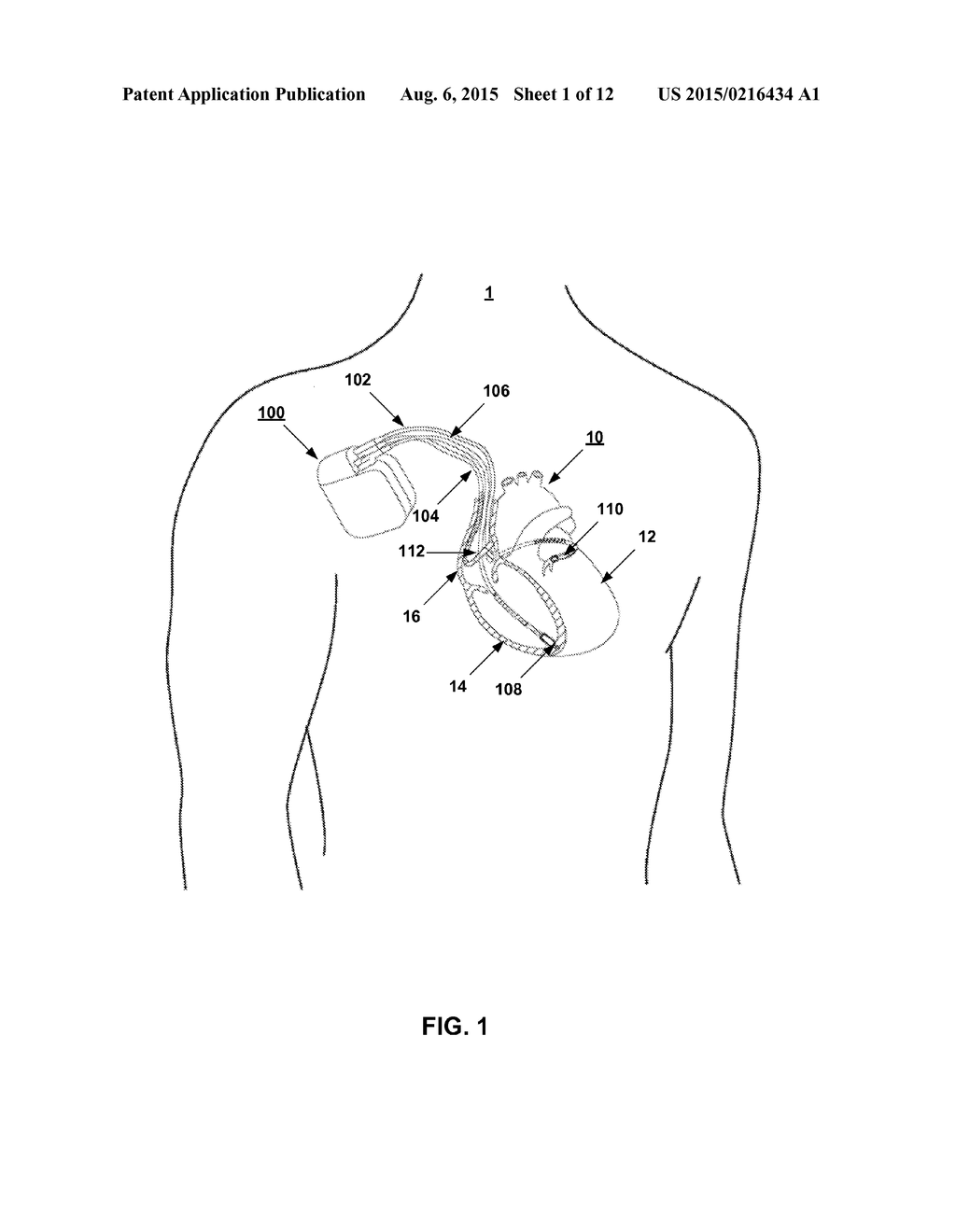 ASSESSING INTRA-CARDIAC ACTIVATION PATTERNS - diagram, schematic, and image 02