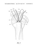 SUTURE ANCHOR diagram and image