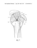 SUTURE ANCHOR diagram and image