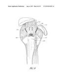 SUTURE ANCHOR diagram and image