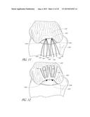 SUTURE ANCHOR diagram and image