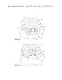 SUTURE ANCHOR diagram and image