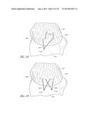 SUTURE ANCHOR diagram and image