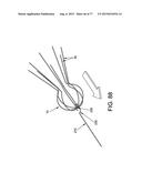 METHOD AND APPARATUS FOR RESTRICTING FLOW THROUGH AN OPENING IN THE SIDE     WALL OF A BODY LUMEN, AND/OR FOR REINFORCING A WEAKNESS IN THE SIDE WALL     OF A BODY LUMEN, WHILE STILL MAINTAINING SUBSTANTIALLY NORMAL FLOW     THROUGH THE BODY LUMEN diagram and image