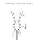 METHOD AND APPARATUS FOR RESTRICTING FLOW THROUGH AN OPENING IN THE SIDE     WALL OF A BODY LUMEN, AND/OR FOR REINFORCING A WEAKNESS IN THE SIDE WALL     OF A BODY LUMEN, WHILE STILL MAINTAINING SUBSTANTIALLY NORMAL FLOW     THROUGH THE BODY LUMEN diagram and image