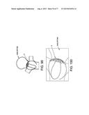 METHOD AND APPARATUS FOR RESTRICTING FLOW THROUGH AN OPENING IN THE SIDE     WALL OF A BODY LUMEN, AND/OR FOR REINFORCING A WEAKNESS IN THE SIDE WALL     OF A BODY LUMEN, WHILE STILL MAINTAINING SUBSTANTIALLY NORMAL FLOW     THROUGH THE BODY LUMEN diagram and image