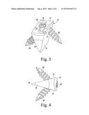 Foot Implant For Bone Fixation diagram and image