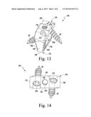 Foot Implant For Bone Fixation diagram and image