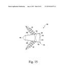 Foot Implant For Bone Fixation diagram and image