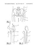 Drill Alignment Device, Method for Manufacturing the Drill Alignment     Device and a Method for Removing Bone Cement diagram and image