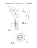 Drill Alignment Device, Method for Manufacturing the Drill Alignment     Device and a Method for Removing Bone Cement diagram and image