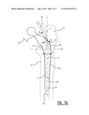 Drill Alignment Device, Method for Manufacturing the Drill Alignment     Device and a Method for Removing Bone Cement diagram and image