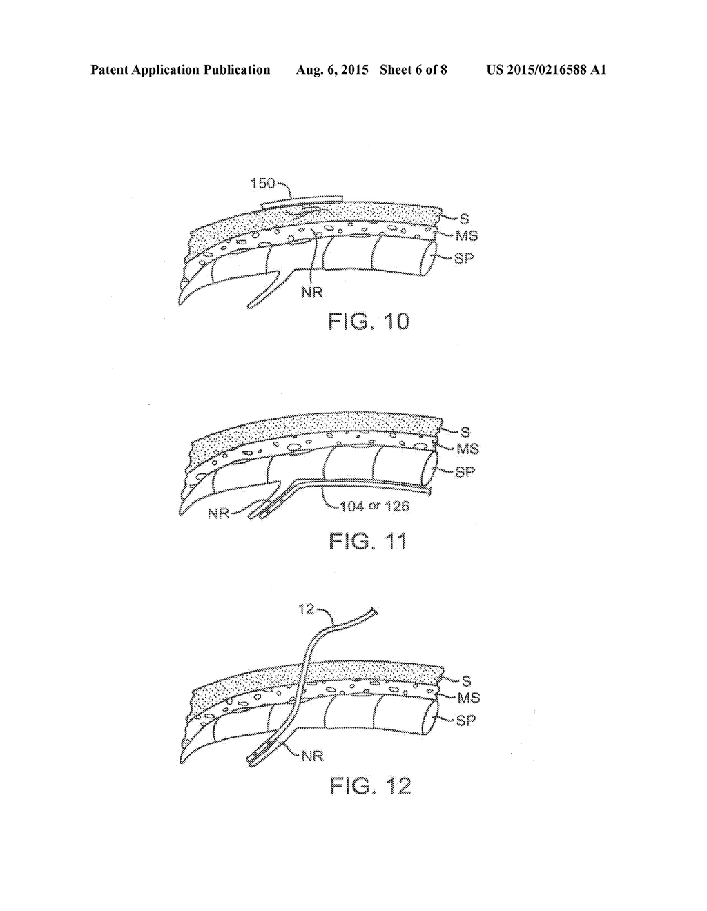 Systems and Methods for Neuromodulation for Treatment of Pain and Other     Disorders Associated with Nerve Conduction - diagram, schematic, and image 07