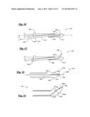 TRANSPEDICULAR ACCESS TO THE INTERVERTEBRAL DISC SPACE FOR DISCECTOMY, END     PLATE PREPARATION, AND INTERBODY FUSION diagram and image