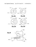 TRANSPEDICULAR ACCESS TO THE INTERVERTEBRAL DISC SPACE FOR DISCECTOMY, END     PLATE PREPARATION, AND INTERBODY FUSION diagram and image