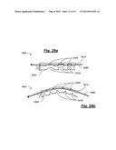 TRANSPEDICULAR ACCESS TO THE INTERVERTEBRAL DISC SPACE FOR DISCECTOMY, END     PLATE PREPARATION, AND INTERBODY FUSION diagram and image