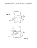 TRANSPEDICULAR ACCESS TO THE INTERVERTEBRAL DISC SPACE FOR DISCECTOMY, END     PLATE PREPARATION, AND INTERBODY FUSION diagram and image