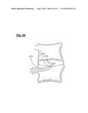 TRANSPEDICULAR ACCESS TO THE INTERVERTEBRAL DISC SPACE FOR DISCECTOMY, END     PLATE PREPARATION, AND INTERBODY FUSION diagram and image