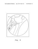 ORTHOPAEDIC IMPLANT TEMPLATE AND METHOD OF MAKING diagram and image