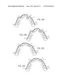 APPARATUS AND METHOD FOR ORTHODONTIC TREATMENT diagram and image