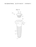 PALATAL IMPLANT FOR OVERDENTURE diagram and image