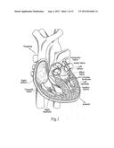 SYSTEMS FOR QUICKLY DELIVERING A PROSTHETIC HEART VALVE diagram and image