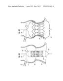 SYSTEMS FOR QUICKLY DELIVERING A PROSTHETIC HEART VALVE diagram and image