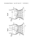 SYSTEMS FOR QUICKLY DELIVERING A PROSTHETIC HEART VALVE diagram and image