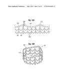 SYSTEMS FOR QUICKLY DELIVERING A PROSTHETIC HEART VALVE diagram and image