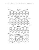 SYSTEMS FOR QUICKLY DELIVERING A PROSTHETIC HEART VALVE diagram and image