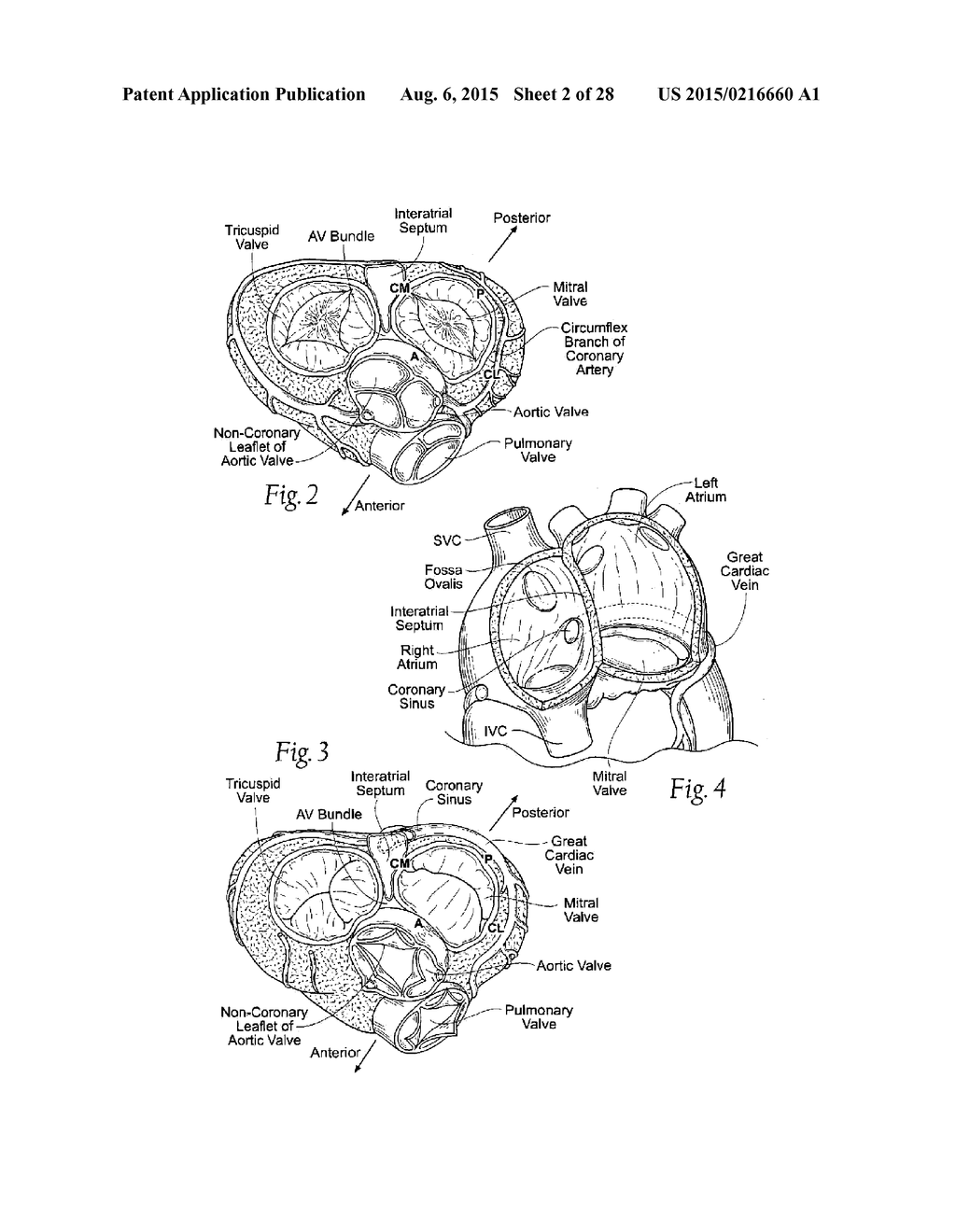 RAPID DEPLOYMENT METHODS FOR PROSTHETIC HEART VALVES - diagram, schematic, and image 03