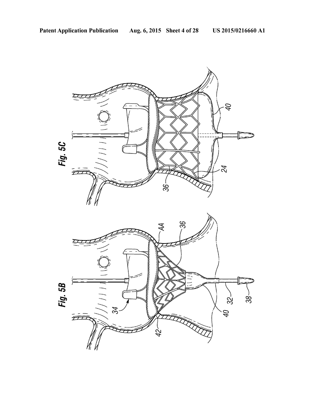 RAPID DEPLOYMENT METHODS FOR PROSTHETIC HEART VALVES - diagram, schematic, and image 05