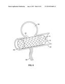 DUAL ROTATIONAL STENT APPARATUS AND METHOD FOR ENDOVASCULAR TREATMENT OF     ANEURYSMS diagram and image