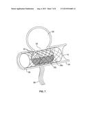 DUAL ROTATIONAL STENT APPARATUS AND METHOD FOR ENDOVASCULAR TREATMENT OF     ANEURYSMS diagram and image