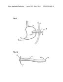 APPARATUS FOR TREATING OBESITY BY EXTRACTING FOOD diagram and image