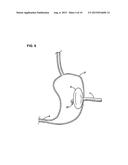 APPARATUS FOR TREATING OBESITY BY EXTRACTING FOOD diagram and image